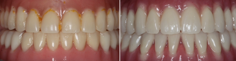 Фото до и после - Удаление зубов мудрости