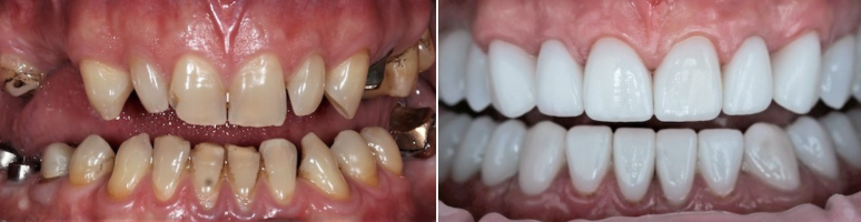 Фото до и после - Панорамный снимок зубов