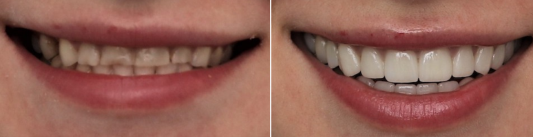 Фото до и после - Вкладки/накладки на зубы